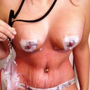 3 day post op.  Hopeing the stretch marks will smooth out in time.