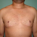 FTM "Top Surgery" Chest Masculinization