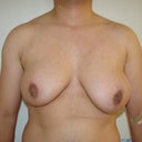 FTM "Top Surgery" Chest Masculinization