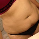 Before surgery