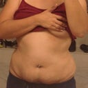 Front has most fat. But skin is loose and will sag unless I get TT. (I'm wearing padded bra so ignore that part)