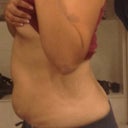 Side view of belly before operation