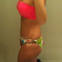 1 month post op