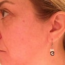 Six month post 4th Fraxel treatment-no makeup