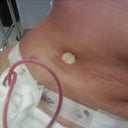 My 24 hr post-op appt. There is my new belly button:)