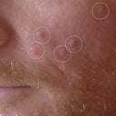 Lumps on cheek