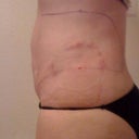 1 day post procedure.