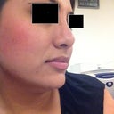 3 months post rhino side no longer droopy nose!!