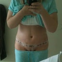 Three days post-op.