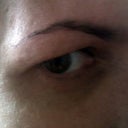 Before close up of eye