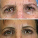 Here's a look at me Before & After. The second shot was taken about a week after my laser eyelid lift. It was incredible at eliminating wrinkles and giving my eyebrows a nice lift!