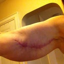 10 1/2 weeks post op