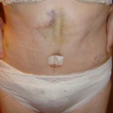 Not a very good photo but gives a hint of what final result will be like ... bit of swelling and bruising but I am very pleased to get rid of pouch and overhang.