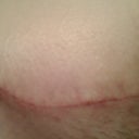 5 weeks po scar.