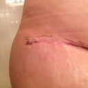 Right side... Possible dog ear?  =(  19 days PO