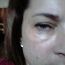 This is what I looked like BEFORE Hyaluronidase.