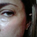 This is what I looked like BEFORE Hyaluronidase.