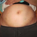 2 days out SWOLLEN