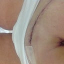 Half glue half stitches... Part of a clinical trial....