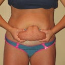 Pre Surgery-front