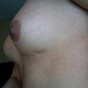 Big scar, and bad location under the muscle.