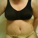 Post Op Day 6 still swollen and feeling bloated!
