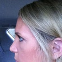 Here I am in the car right after the cast was removed. I still have some bruises under my eyes and my cheeks are a little swollen, but I look pretty good for six days post op.