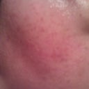 12 HOUR POST TREATMENT - RIGHT SIDE