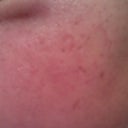 12 HOUR POST-TREATMENT - LEFT SIDE