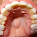 Inside mouth, upper teeth. Awful job of veneers!