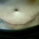 11 days post op.