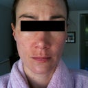 Day 2-  Areas of my face have turned brown and patchy.  It seems as if the hyperpigmentation has momentarily gotten darker. Peeling has started around my mouth by afternoon and I'm starting to understand there is a bit of 'downtime' involved.  mineral make up can play down the effects, but the darkness is still noticeable.