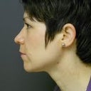 After (3/2012)