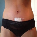 Post op day 5