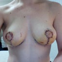 6 days post-op