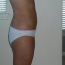 JANUARY 22, 2011
16 DAYS AFTER SURGERY