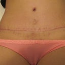 2months-only nice outcome is scar and BB. scar is very smooth and flat.  used silicone strips for about 1-2weeks and not using any scar treatments now.