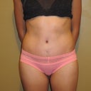 2months PO- still very swollen