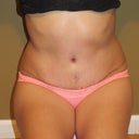 2months PO- sitting straight up