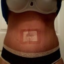 11 days post op