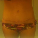 18 weeks scar