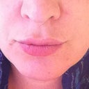 Prior to Micro Liposuction of Chin & Neck (front view)