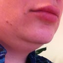 Prior to Micro Liposuction of Chin & Neck (side view)