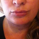 Less than 30 minutes after procedure (front view) Please note bruising.