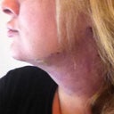 Less than 30 minutes after procedure (side view) Please note bruising.
