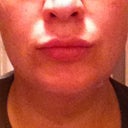 Day 1 of procedure, about 16 hours after procedure. I iced my site every 2 hours for 20 minutes, note the decrease in bruising.  (Plus, other than minimal swelling... my friends did not mention anything about my chin or neck)!