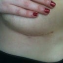 2 1/2 weeks - scar