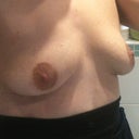 2 1/2 weeks - No fluff fairy yet but they definitely feel more a part of me than the sore, saggy things I had right after surgery :)