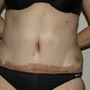 1 Week post-op