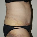 1 Week post-op